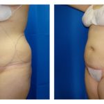 Female Liposuction Before & After Patient #202