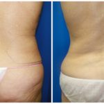 Female Liposuction Before & After Patient #204